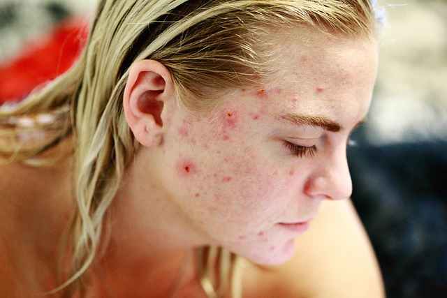 Can Dogs Really Cause Acne? The Surprising Answer